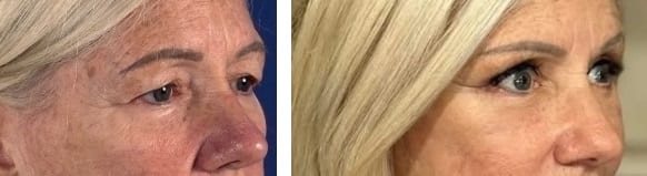 Cirugía de la Mirada caso 3 — antes y después